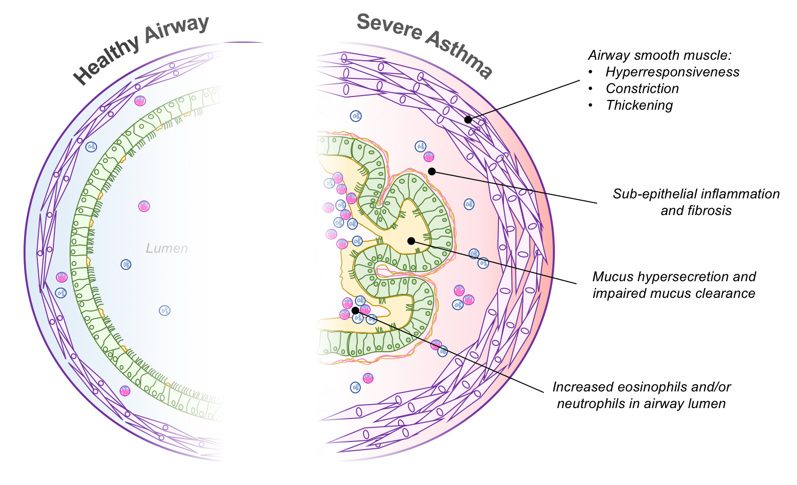 info-graphic about Severe Asthma Pathophysiology, Healthy airway and what is severe asthma