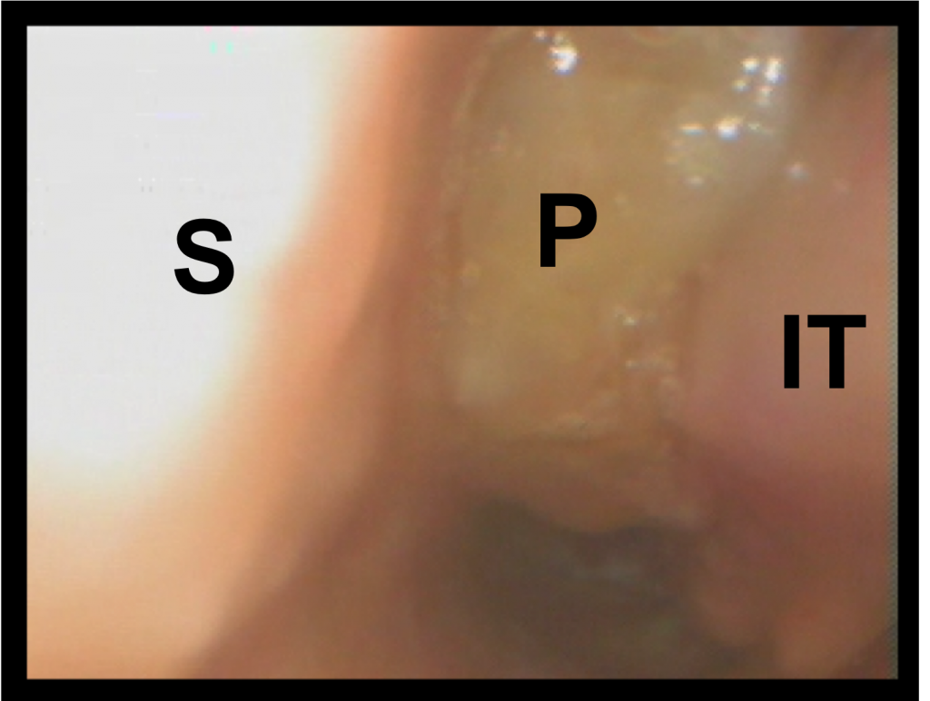 Chronic Rhinosinusitis And Severe Asthma Severe Asthma Toolkit   Polyps 1 1024x772 