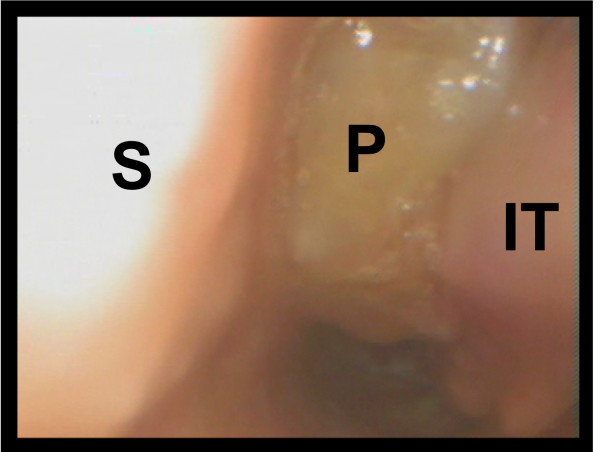 Visual inspection with anterior rhinoscopy may detect large polyps, but fibreoptic nasendoscopy is required to detect smaller polyps around the osteomeatal complex.