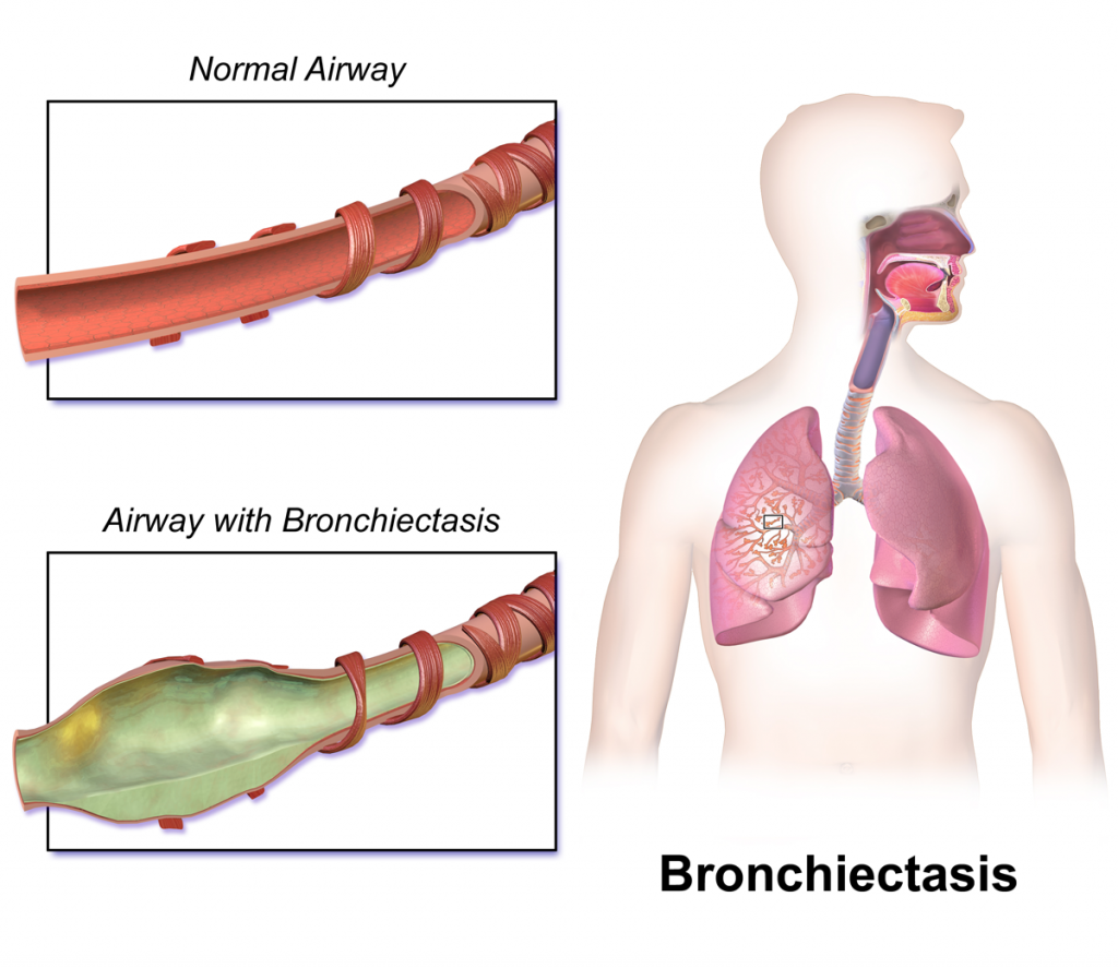 bronchiectasis